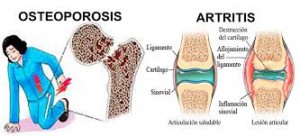 osteoporosis
