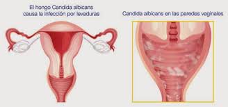Candidiasis: síntomas, tipos, diagnóstico y tratamiento