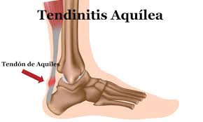 TENDINITIS