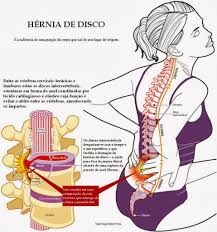 hernia1