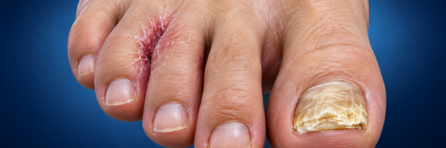 Infecciones por hongos en los pies: pie de atleta y onicomicosis